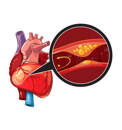 d694cb95388f6d036e5185a35154209b 9573 heart attack stock illustrations cliparts and royalty free 422 450