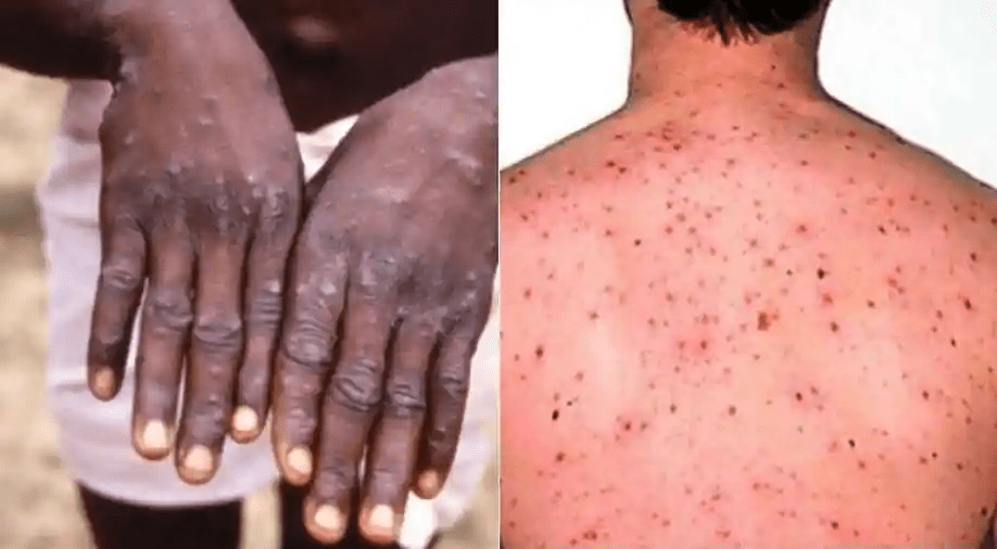 Case reports of monkey pox infection in 11 countries, including Europe, USA and Canada
